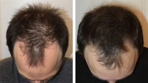 מיכאל - תוצאות Growband מהאתר הרשמי של Hairguard